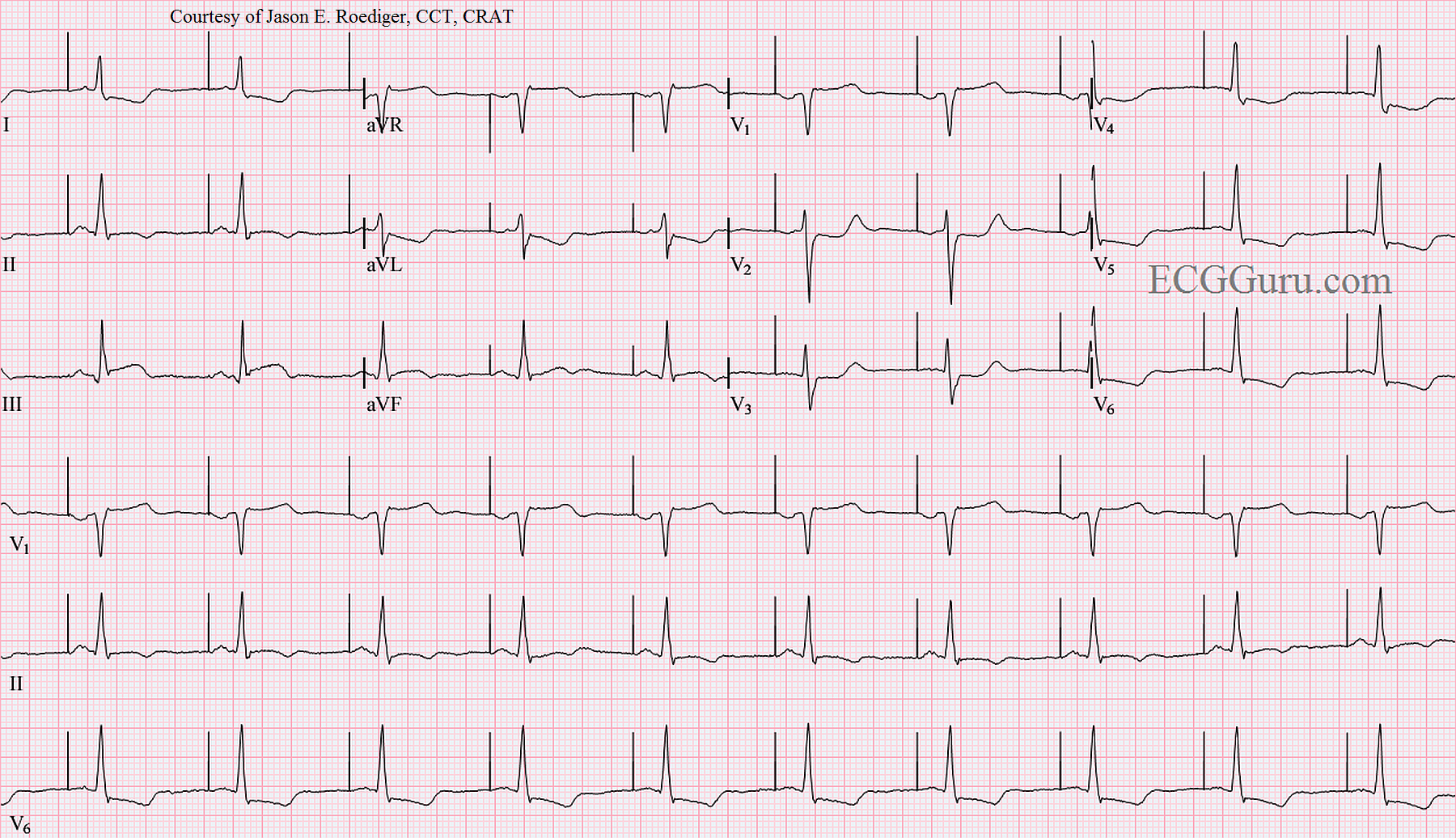 Atrial Pacing in a Patient With Acute Inferior Wall M.I. | ECG Guru